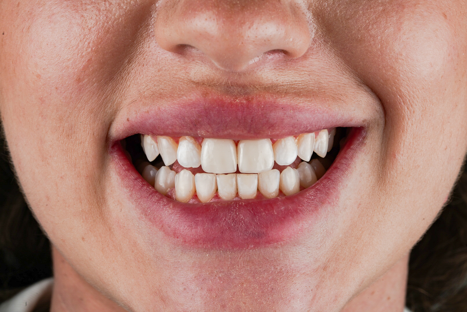 fazety-predne-zuby
